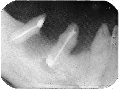 Obturation of the second bicuspid and distal root of hemisected first molar. Note the periapical lesion and slight extrusion of sealer beyond the apex of the bicuspid.