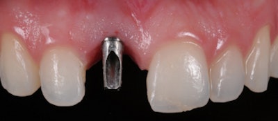 The missing upper right central incisor is a perfect candidate for a single-tooth implant