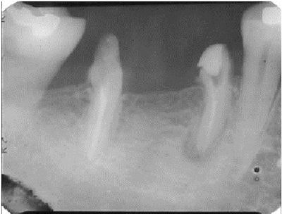 Root canal therapy was done on the mesial roots. The mesial canals were obturated with Pulpdent Root Canal Sealer using the Pressure Syringe technique. The teeth were hemisected, and the distal roots were removed.