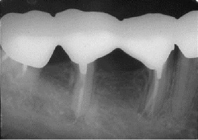 Seven-year follow-up radiograph shows healthy bone and the bridge in place.