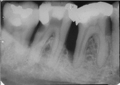 Bone loss around the distal roots of teeth Nos. 30 and 31. All radiograph images courtesy of Dr. Harold Berk.