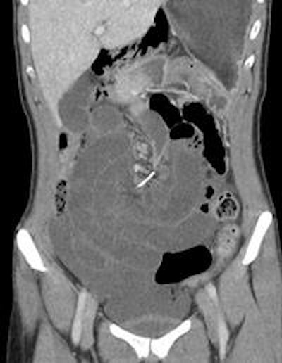 Coronal CT image of orthodontic wire at the root of the small-bowel volvulus. Image courtesy of BMJ Case Reports.