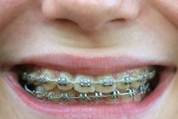 2017 08 08 14 02 40 142 Braces 400