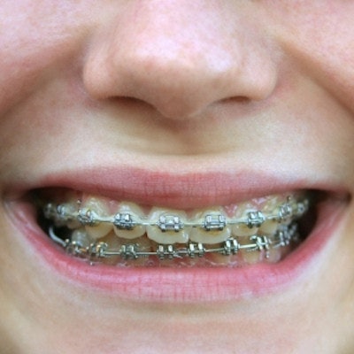 Doctors Remove Braces Wire from Woman's Intestine 10 Years After  Orthodontics Removal