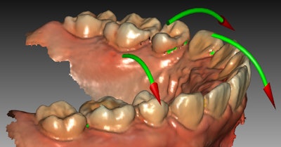 An example of the green guide arrows in the updated CS 3600 scanner software. Image courtesy of Carestream Dental.