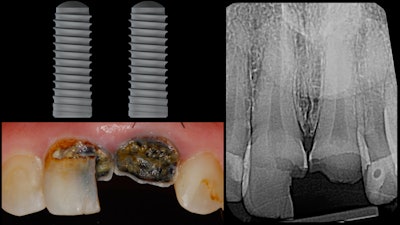 Figure 1: The treatment plan for the patient's teeth Nos. 8 and 9. All images courtesy of Dr. Ross Enfinger.