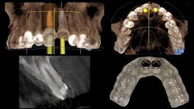 Figure 2: The surgical guide used for this patient's treatment.