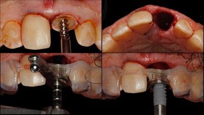 Figure 3: The implant being placed.