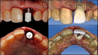 Figure 4: Imaging and design of implant provisional.