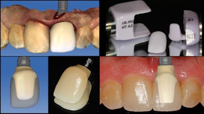 Figure 6: The bonded abutment.