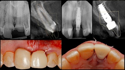 Figure 5: Care was taken to leave the restoration out of occlusion.