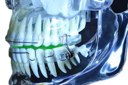 2018 02 28 18 06 4137 Cfdsm Meridian Pm Apnea Appliance 20180228181927