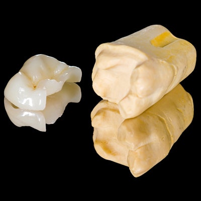 2018 02 14 22 40 4611 Tooth Ceramic Inlay 400