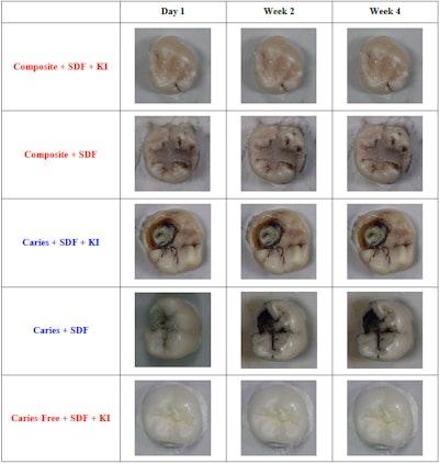 Potassium iodide prevented discoloration for restored teeth treated with SDF. Image courtesy of Carolyn Primus, PhD.
