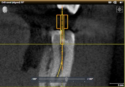 A screen capture of a drill canal in the Sicat Endo software. Image courtesy of Dentsply Sirona.
