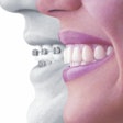 2016 08 31 14 35 58 82 Invisalign 400