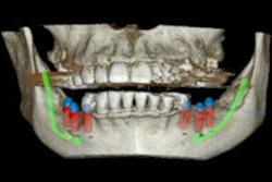 2017 08 03 14 25 01 143 Cbct 3 D Implants 400