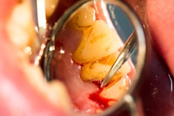 2018 09 24 20 50 5142 Periodontal Treatment Mirror 400