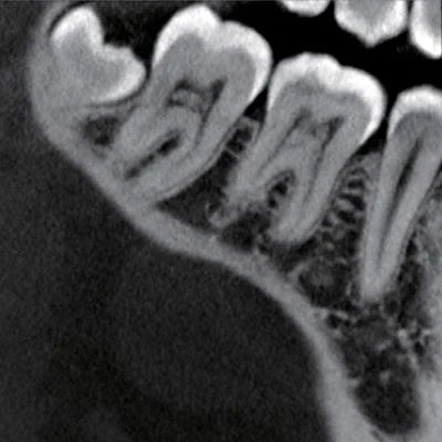 Pulpstone Radiograph Study compares CBCT, digital radiography for pulp stone imaging ...