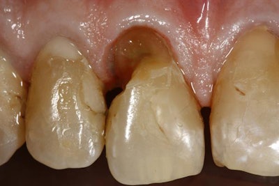 Tooth No. 8 after the gingivectomy but before final restoration.