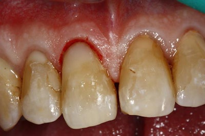 The restored tooth immediately after the procedure.