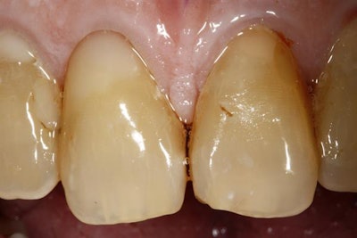 The restored tooth at follow-up six days after the procedure.