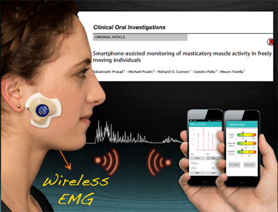 A new prototype wirelessly monitors jaw muscle contractions. Image courtesy of Dr. Mauro Farella.