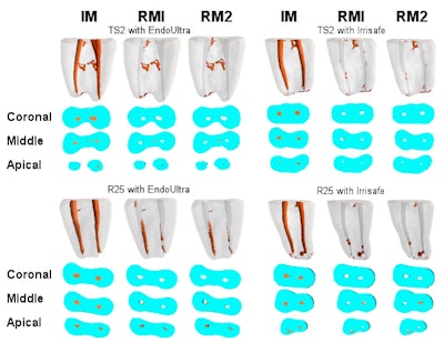 Reconstructed 3D micro-CT images and cross-sections for groups TS2 with EndoUltra, TS2 with Irrisafe, R25 with EndoUltra, and R25 with Irrisafe, including initial material (IM), residual material (RM1), and the residual material after passive ultrasonic activation (RM2), with the corresponding technique. Image courtesy of Kaloustian et al, 'Evaluation of two shaping systems and two ultrasonic irrigation devices in removing root canal rilling material from mesial roots of mandibular molars: A micro-CT study, Dentistry Journal, January 2019, Vol. 7:1, p. 2.