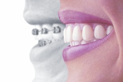 2016 08 31 14 35 58 82 Invisalign 400