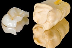2018 02 14 22 40 4611 Tooth Ceramic Inlay 400