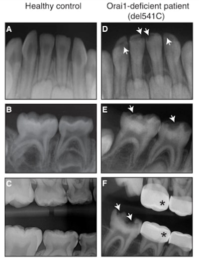 Teeth of a healthy control versus the patient with an ORAI mutation. From Eckstein et al., Sci. Signal. 12, eaav4663 (2019). Reprinted with permission of AAAS.