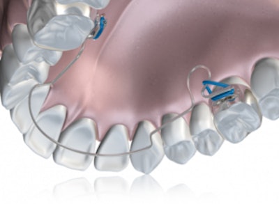 Advanced lightwire functional appliance. Image courtesy of Dr. Martin Gorman.