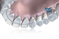 2019 05 22 21 00 7944 2019 05 23 Advanced Lightwire Appliance 400