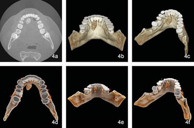 Patient with a salivary gland stone visualized with axial cone-beam CT (a), conventional volume rendering reconstruction of cone-beam CT scans (b, c), cinematic rendering of cone-beam CT scans (d-f). Image courtesy of Dr. Sebastian Winklhofer.