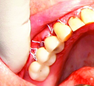 Above: The full-thickness flap was heavily released for untensioned closure. The prosthesis was placed in implant-protected occlusion, and an occlusal guard was seated six weeks after the procedure. Below: The patient’s mouth immediately after the procedure.