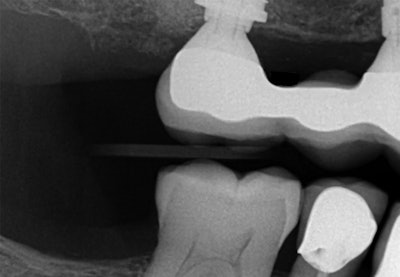 Above: Preoperative radiograph of the implant on tooth #5. Below: Peri-implant disease is shown around the coronal portion of implant #5. All images courtesy of Dr. Daniel Haghighi.