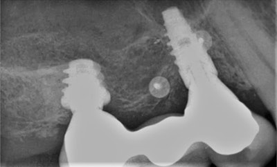 Periapical radiograph of implant #5 at one-year follow-up demonstrates excellent maintenance of peri-implant coronal bone levels.
