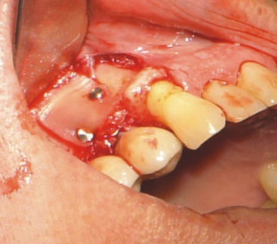 Above: Tacks were used to stabilize bone sheet. Below: A platelet-rich fibrin membrane is placed over the secured bone sheet.