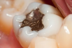 2016 10 11 15 50 56 325 Amalgam Filling 400