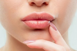 2019 11 01 15 50 3722 Lips Injection 400
