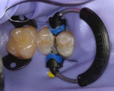 Garrison sectional matric system