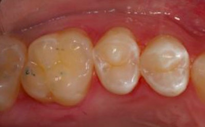 Banking tooth structure