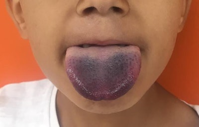 After removal of the bottle with positive pressure, the boy's tongue remained discolored for a few days but fully recovered within 14 days.