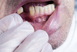 2019 12 09 19 43 8528 Missing Tooth Edentulism 400