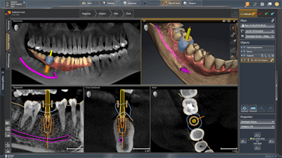 The SICAT Implant 2.0 software. Image courtesy of SICAT.