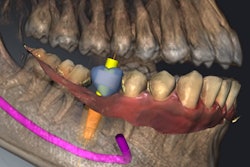 2019 12 11 19 16 5900 Sicat Implant 2 0 20191211192940