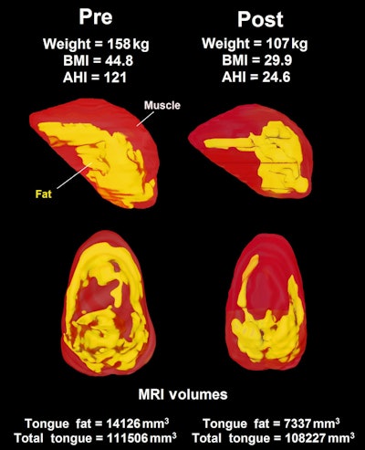 Three-dimensional reconstruction of tongue (red) and tongue fat (yellow) derived from axial MRI and fat-only MRI show the loss of tongue fat between baseline and six-month follow-up in the same male patient. BMI: body mass index; AHI: apnea-hypopnea index. Images courtesy of American Journal of Respiratory and Critical Care Medicine.