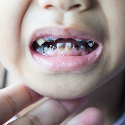 2020 01 16 22 52 5146 Child Caries Tooth Decay 400