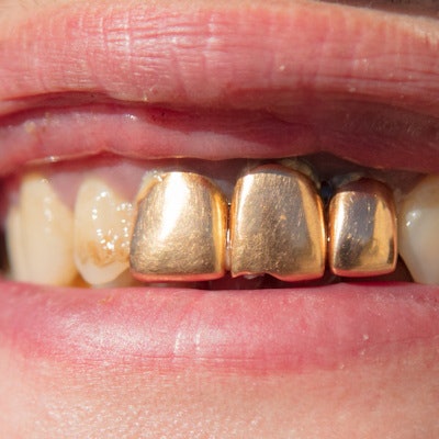 2020 01 29 23 10 7673 Teeth Gold 400