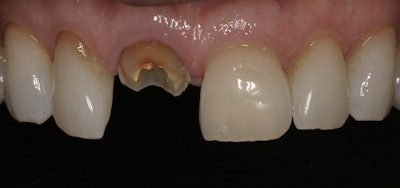 Patient presented with a fractured endodontically treated central incisor